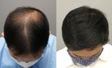 Dr. Kongkiat Laorwong, MD, FISHRS,  FUE 3150 grafts, 8 months post op