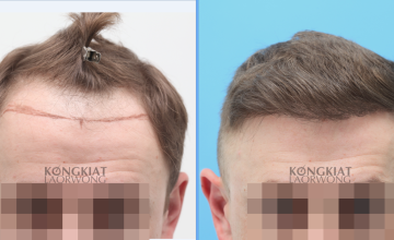 Dr.Kongkiat Laorwong, FISHRS, Thailand, FUE FUE 2145 grafts, 2 years 6 months result