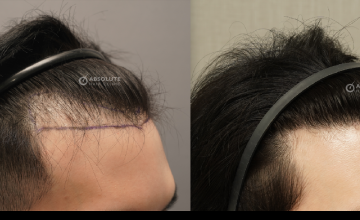Dr. Kongkiat Laorwong, MD, FISHRS, hairline FUE 1700 grafts, 12 months post op
