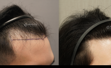 Dr. Kongkiat Laorwong, MD, FISHRS,  hairline FUE 1700 grafts, 12 months post op