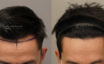 Dr. Kongkiat Laorwong, MD, FISHRS, male hairline FUE 1845 grafts, 11 months post op