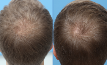 FUE 2000 grafts, Dr. Kongkiat Laorwong, Bangkok