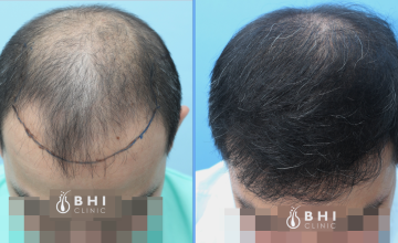 Dr. Kongkiat Laorwong, MD, Bangkok, FUE 3412 grafts, 10 months result