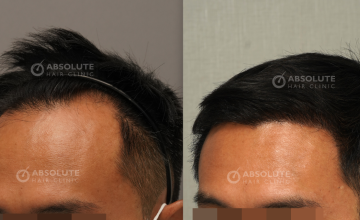Dr. Kongkiat Laorwong, MD, FISHRS, FUE 3400 grafts, 5 months post op