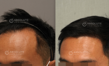 Dr. Kongkiat Laorwong, MD, FISHRS,  FUE 3400 grafts, 5 months post op