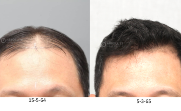 Dr. Kongkiat Laorwong, MD, FISHRS, FUE 4000 grafts, 10 months post op