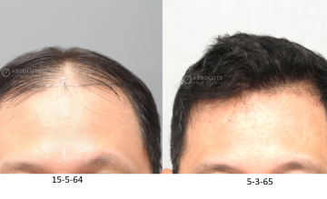 Dr. Kongkiat Laorwong, MD, FISHRS,  FUE 4000 grafts, 10 months post op