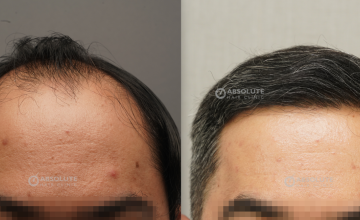 Dr. Kongkiat Laorwong, MD, FISHRS, FUE 3500 grafts, 8 months post op.