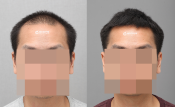 Dr. Kongkiat Laorwong, MD, FISHRS,  FUE 3238 grafts, 12 months post op