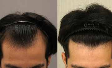 Dr. Kongkiat Laorwong, MD, FISHRS,  FUE 3400 grafts, 8 months post op