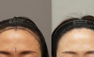 Dr. Kongkiat Laorwong, MD, FISHRS, Female hairline,non shaven FUE 1500 grafts, 12 months post op