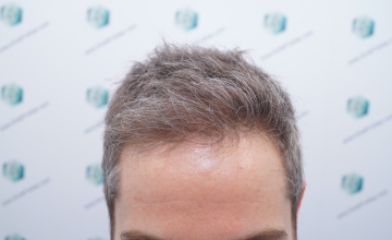 Dr. Rafael de Freitas - 3010 Grafts / 6843 Hairs - FUE