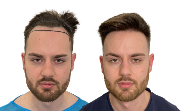 Dr Matt Egan - 1914 Grafts | FUE | Hairline | 12 Month Results