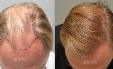 Dr. Kongkiat Laorwong, MD, FISHRS,  FUE 3600 grafts, 2 years post op