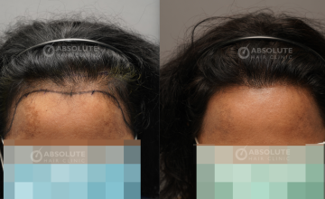 Dr. Kongkiat Laorwong, MD, FISHRS, Female non shaven FUE 2800 grafts, 9 months post op