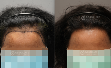 Dr. Kongkiat Laorwong, MD, FISHRS,  Female non shaven FUE 2800 grafts, 9 months post op