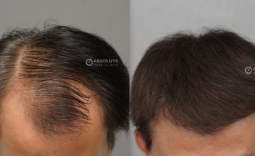 Dr. Kongkiat Laorwong, MD, FISHRS, FUE 3200 grafts, 6 months post op