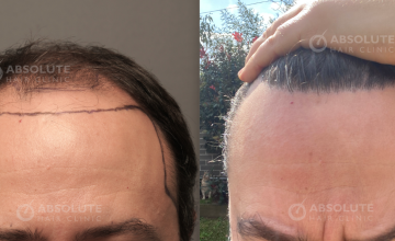 Dr. Kongkiat Laorwong, MD, FISHRS, FUE 4126 grafts, 6 months post op