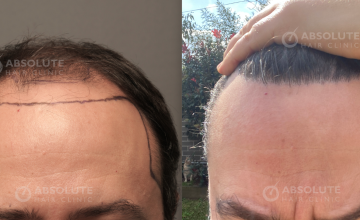 Dr. Kongkiat Laorwong, MD, FISHRS,  FUE 4126 grafts, 6 months post op