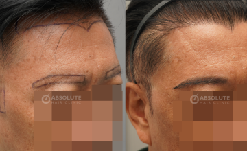 Dr. Kongkiat Laorwong, MD, FISHRS,  Hairline Eyebrows Sideburns FUE 2054 grafts, 10 months post op