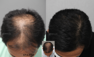 Dr. Kongkiat Laorwong, MD, FISHRS,  FUE 3770 grafts, 11 months post op