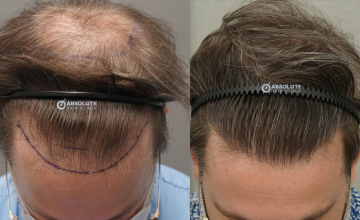Dr. Kongkiat Laorwong, MD, FISHRS, FUE 3567 grafts, 8 months post op