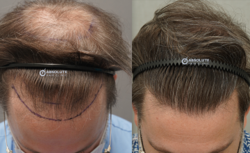 Dr. Kongkiat Laorwong, MD, FISHRS,  FUE 3567 grafts, 8 months post op