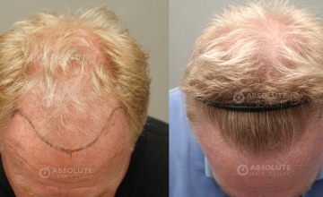 Dr. Kongkiat Laorwong, MD, FISHRS, FUE 3500 grafts, 8 months post op