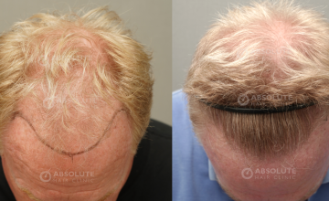 Dr. Kongkiat Laorwong, MD, FISHRS,  FUE 3500 grafts, 8 months post op