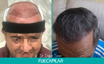 Dr. Turan - FUECAPILAR Clinic, NW Va, 4150 grafts