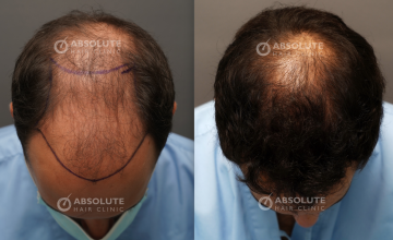 Dr. Kongkiat Laorwong, MD, FISHRS, FUE 4050 grafts, 10 months post op