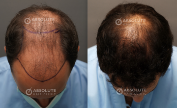 Dr. Kongkiat Laorwong, MD, FISHRS,  FUE 4050 grafts, 10 months post op