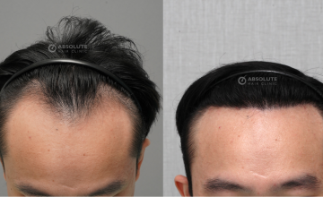 Dr. Kongkiat Laorwong, MD, FISHRS, FUE 2500 grafts, 7 months post op