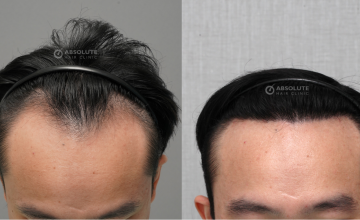 Dr. Ratchathorn Panchaprateep FUE 2500 grafts, 7 months post op