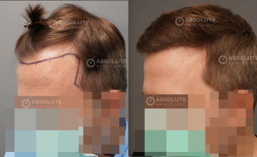 Dr. Kongkiat Laorwong, MD, FISHRS, FUE 3500 grafts hairline and crown