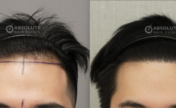 Dr. Kongkiat Laorwong, MD, FISHRS, FUE 1900 grafts, 10 months post op