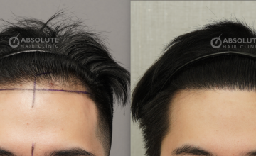 Dr. Ratchathorn Panchaprateep FUE 1900 grafts, 10 months post op