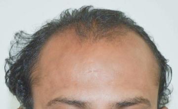 Dr. Suneet Soni - 3800 FUT Grafts, NW IV