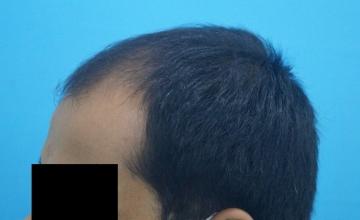 2035 Grafts Hair Transplant Result | Dr Kapil Dua @ AK Clinics