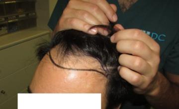 HDC clinic in Cyprus, Dr. Maras FUE 2700 grafts for NW3 class