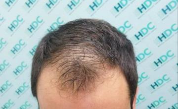 Dr. Christina at HDC clinic in Cyprus, 2550 grafts for NW3