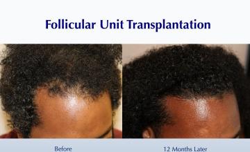 African-American Healthy Hairline (2415 FUT grafts): Carlos K. Wesley, M.D. (NYC & LA)