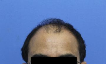 Dr Kapil Dua - FUT Hair Transplant - 4000 Grafts- NH Grade VI (12 months post op)