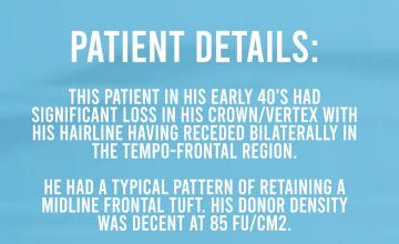 FUE hair transplant by Dr Arshad - The Hair Dr Clinic, Leeds (UK) - 3735 grafts (patient taken after images)