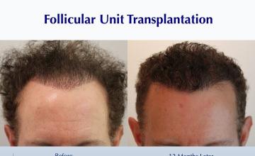 Repairing a “Pluggy” Patient Combining FUT & FUE (2315 grafts): Carlos K. Wesley, M.D. (NYC & LA)