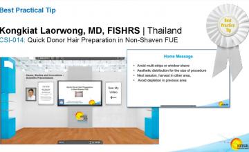 Dr. Kongkiat Laorwong, MD, FISHRS,  hairline FUE 2100 grafts, 5 months post op