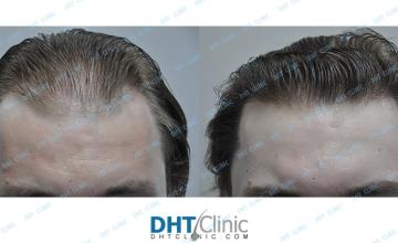 Dr. Damkerng Pathomvanich (DHT Clinic) / FUT 2,161 grafts 8 months post op