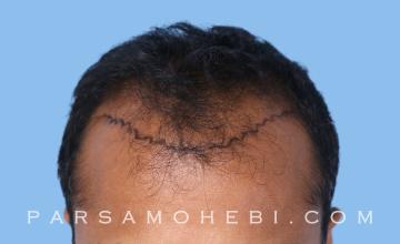 35 Year Old Male with Class III Hair Loss by Dr. Parsa Mohebi