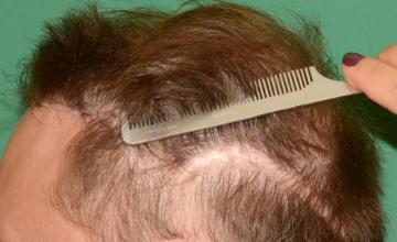 Raymond Konior, MD | Chicago Hair Institute | 3,685 Graft Hairline Repair of Frontal Flap