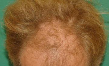 Raymond Konior, MD | Chicago Hair Institute | 1569 Graft Hairline Repair